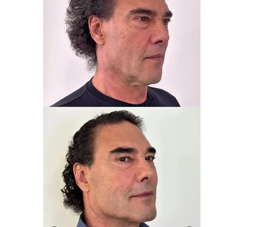 Este es el antes y despu&eacute;s de Eduardo Y&aacute;&ntilde;ez.<br>