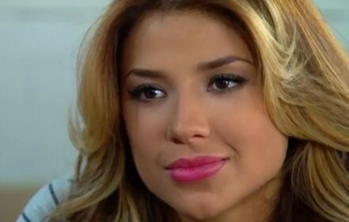 A pesar de su mala experiencia, tiempo después se hizo una rinomodelación de nariz también con ácido hialurónico.