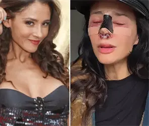 "Fue una mala praxis": Dorismar reaparece tras cirug&iacute;a est&eacute;tica que le desfigur&oacute; el rostro 