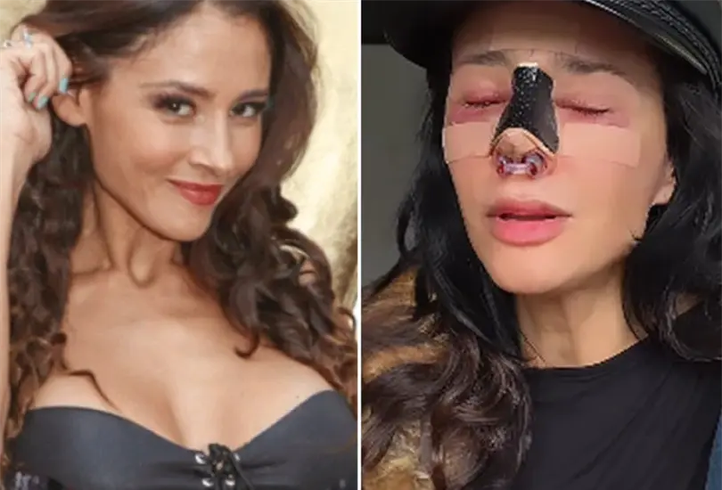 La actriz de "Gata salvaje" dio a conocer que tras una mala cirugía estética se encuentra actualmente en rehabilitación. La actriz de "Gata salvaje" dio a conocer que tras una mala cirugía estética se encuentra actualmente en rehabilitación.