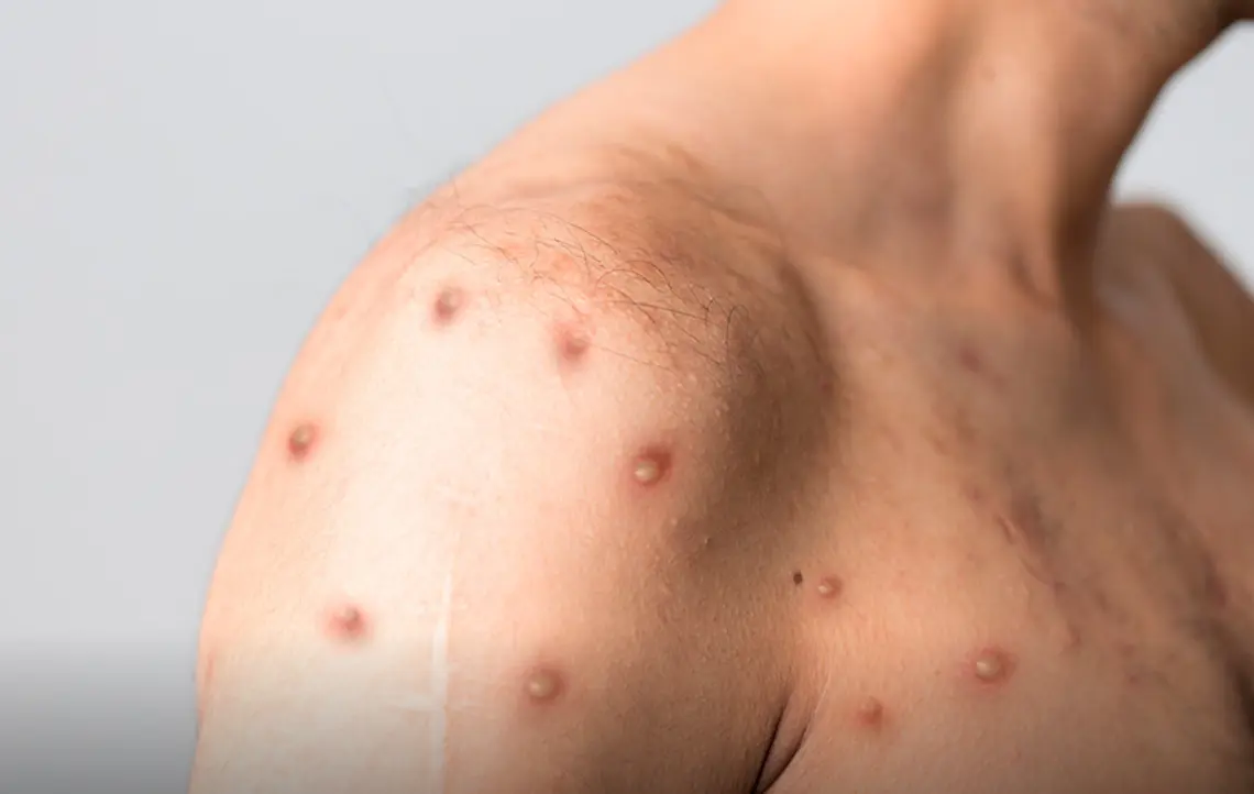 La viruela símica (mpox) se transmite principalmente por contacto cercano con personas infectadas. Especial