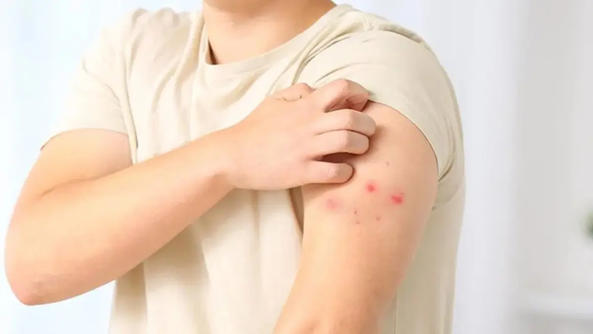  México confirma el primer caso de viruela símica en un ciudadano alemán que viajó por varias entidades. 