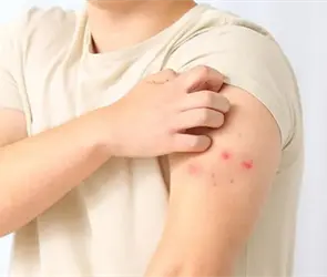 Viruela s&iacute;mica llega a M&eacute;xico; Secretar&iacute;a de Salud confirma el primer caso 