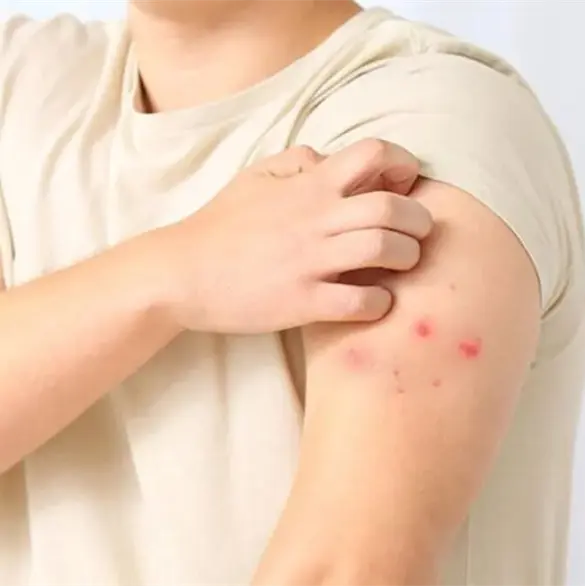 Viruela s&iacute;mica llega a M&eacute;xico; Secretar&iacute;a de Salud confirma el primer caso 