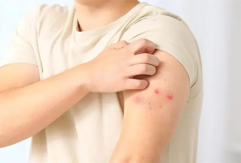 México confirma el primer caso de viruela símica en un ciudadano alemán que viajó por varias entidades. México confirma el primer caso de viruela símica en un ciudadano alemán que viajó por varias entidades.