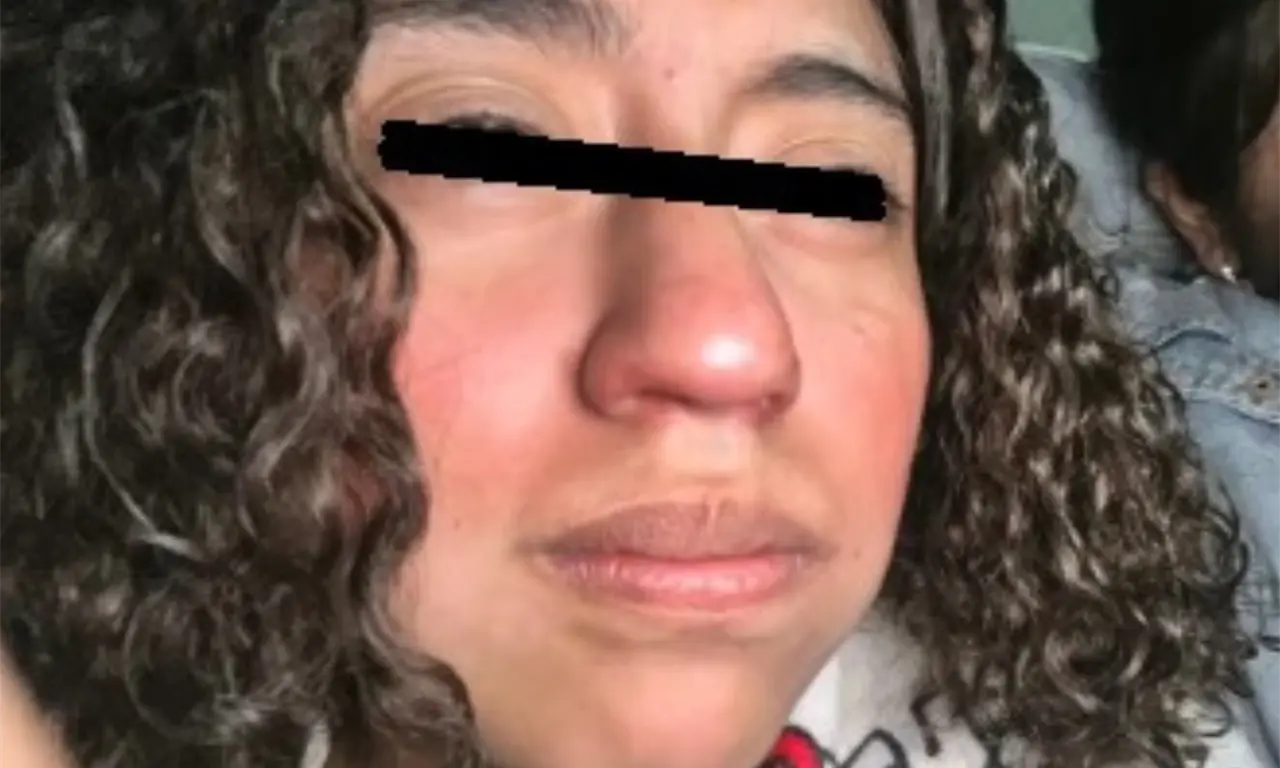  Los reportes médicos indicaron que presentaba quemaduras en aproximadamente el 70 por ciento de su cuerpo, de segundo y tercer grado. 