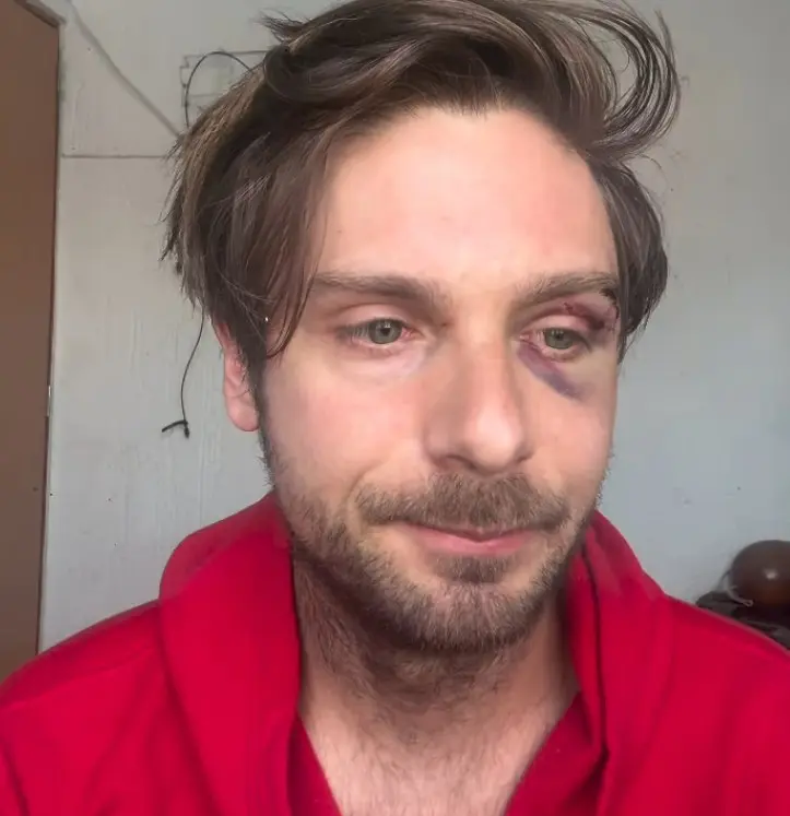 Joan Kuri muestra las heridas que sufrió Instagram