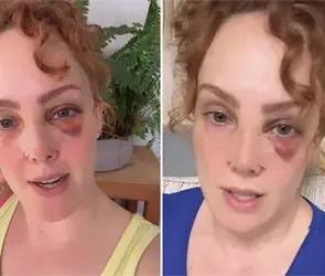 Fran Meric preocupa a seguidores tras aparecer con un ojo morado y golpes en la cara