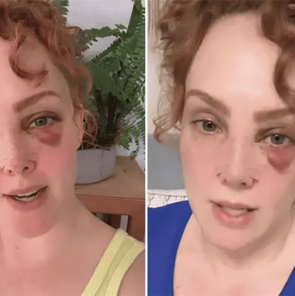 Fran Meric preocupa a seguidores tras aparecer con un ojo morado y golpes en la cara