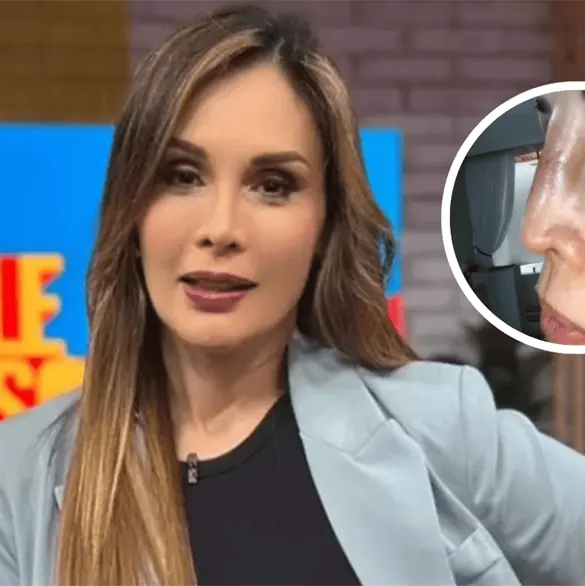 Me dejaron sin hueso: Conductora de Sale el Sol pierde la función de su nariz tras cirugía estética Me dejaron sin hueso: Conductora de Sale el Sol pierde la función de su nariz tras cirugía estética