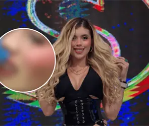 Isabella Rojas muestra c&oacute;mo qued&oacute; su rostro tras ser golpeada con un dron que pate&oacute; Ernesto Chavana