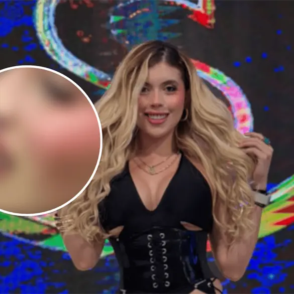 Isabella Rojas muestra c&oacute;mo qued&oacute; su rostro tras ser golpeada con un dron que pate&oacute; Ernesto Chavana