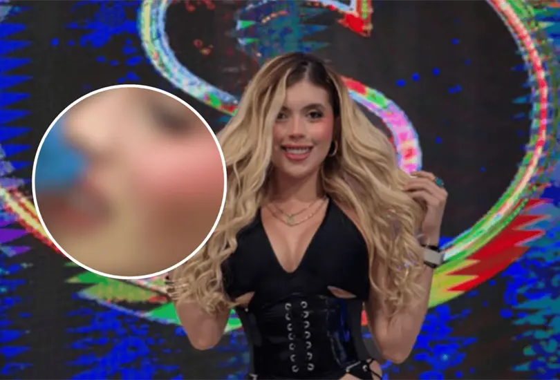 Así quedó el rostro de Isabella Rojas tras recibir un golpe de dron durante una emisión de Es Show; Ernesto Chavana habló sobre lo ocurrido. Así quedó el rostro de Isabella Rojas tras recibir un golpe de dron durante una emisión de Es Show; Ernesto Chavana habló sobre lo ocurrido.